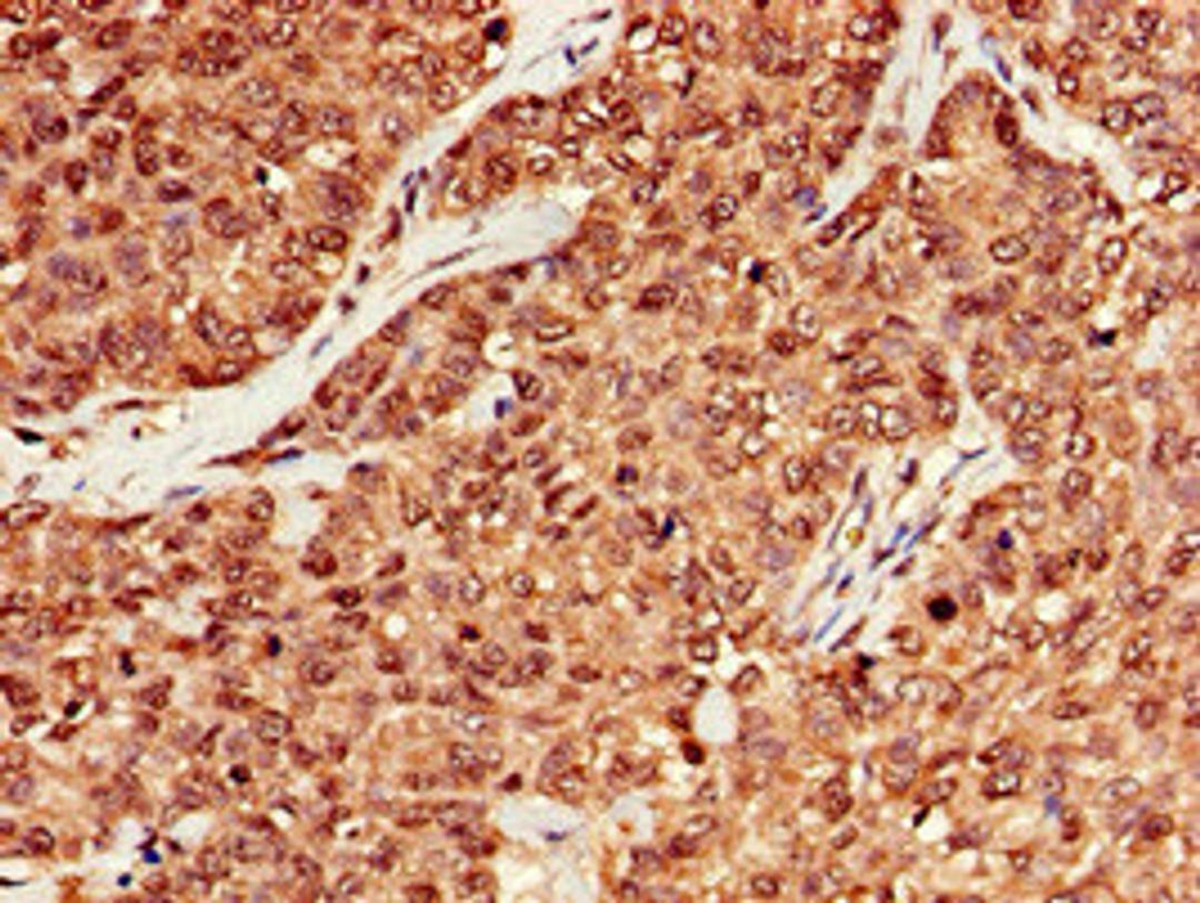 Immunohistochemistry of paraffin-embedded human ovarian cancer using CSB-PA014786EA01HU at dilution of 1:100