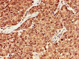 Immunohistochemistry of paraffin-embedded human ovarian cancer using CSB-PA014786EA01HU at dilution of 1:100