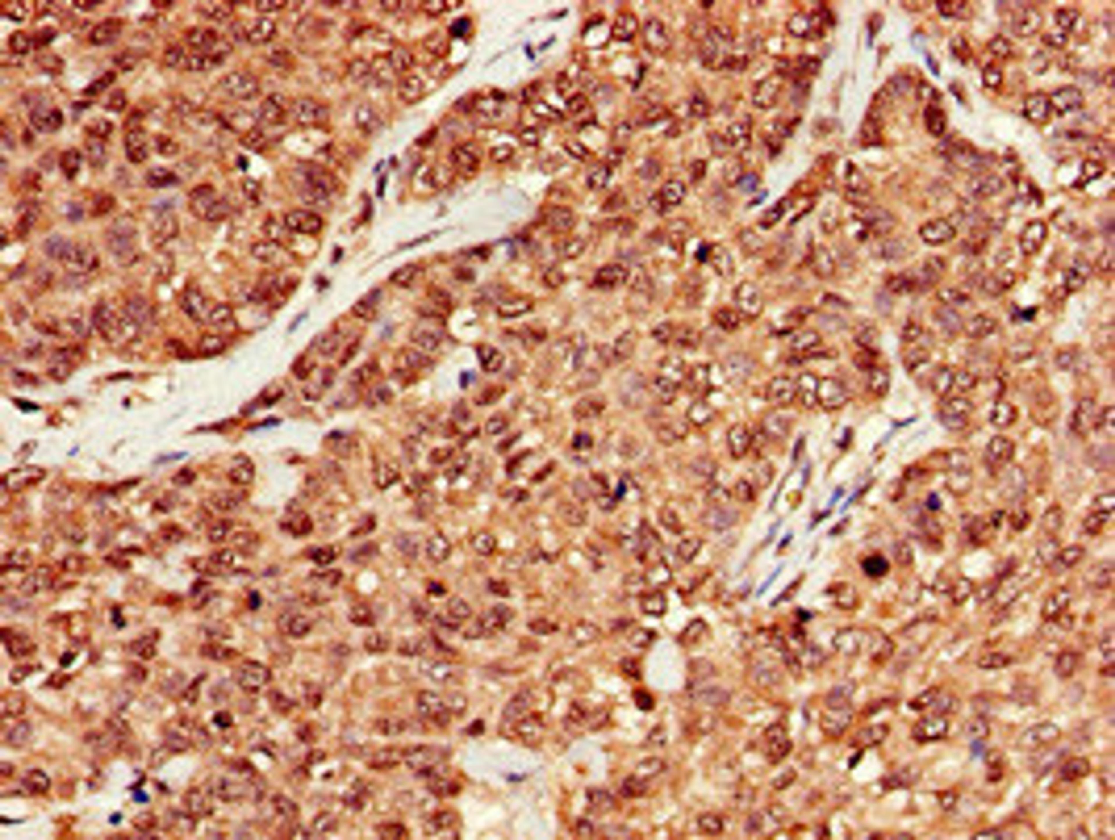Immunohistochemistry of paraffin-embedded human ovarian cancer using CSB-PA014786EA01HU at dilution of 1:100