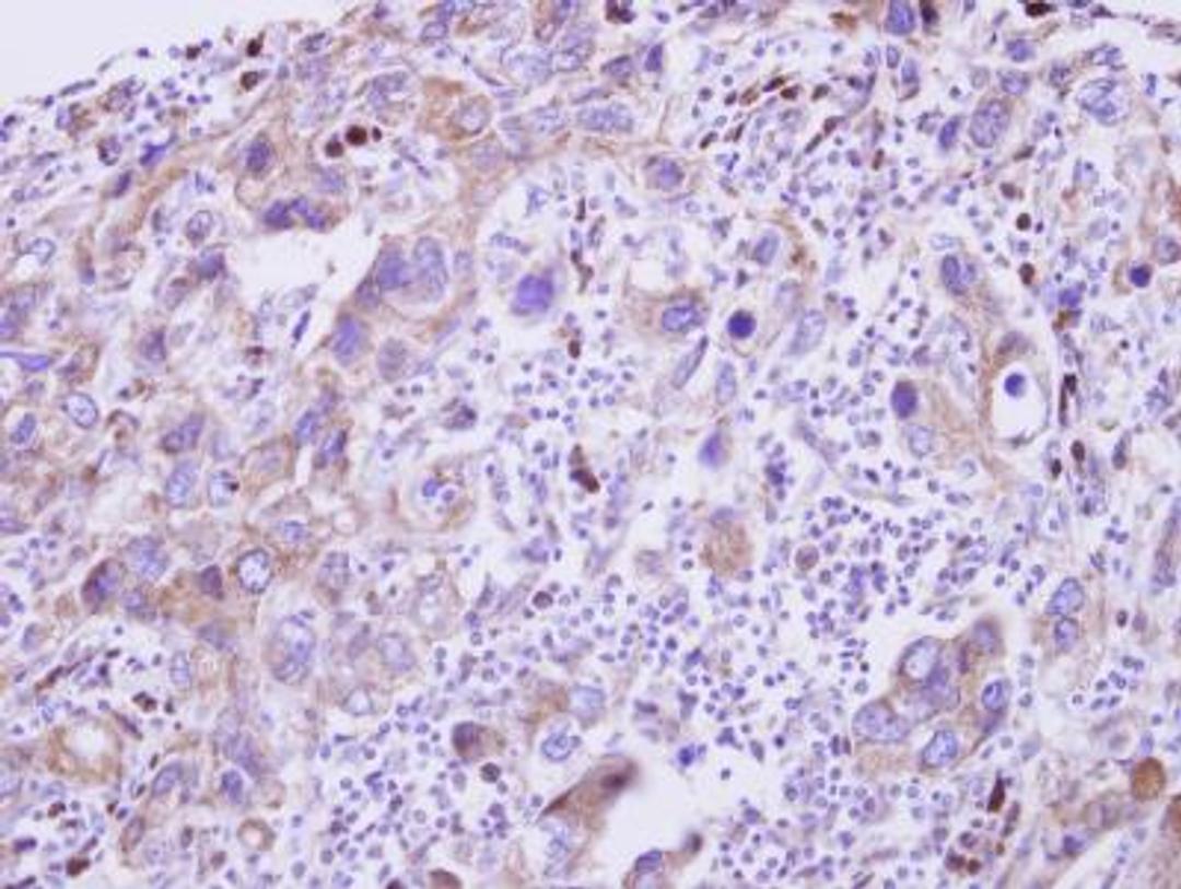 Immunohistochemistry-Paraffin: GDF-5/BMP-14 Antibody [NBP2-16632] - Paraffin-embedded Breast Carcinoma.