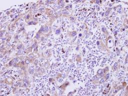 Immunohistochemistry-Paraffin: GDF-5/BMP-14 Antibody [NBP2-16632] - Paraffin-embedded Breast Carcinoma.