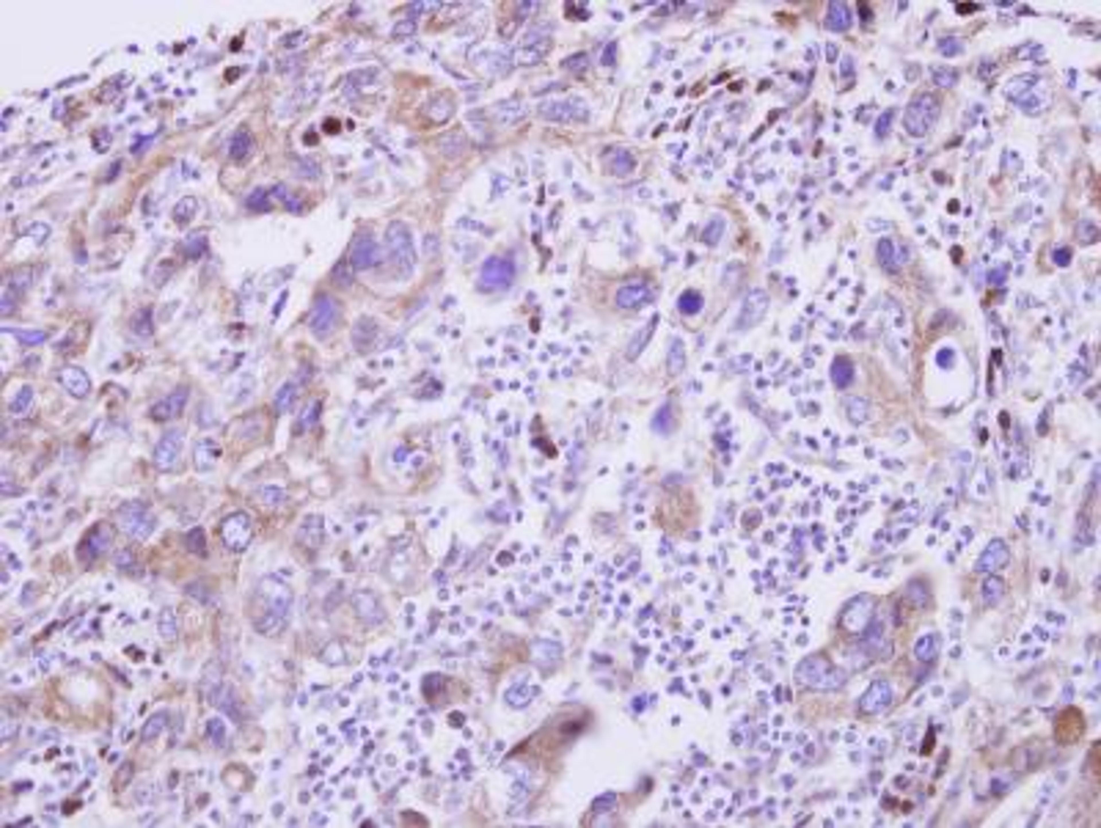 Immunohistochemistry-Paraffin: GDF-5/BMP-14 Antibody [NBP2-16632] - Paraffin-embedded Breast Carcinoma.