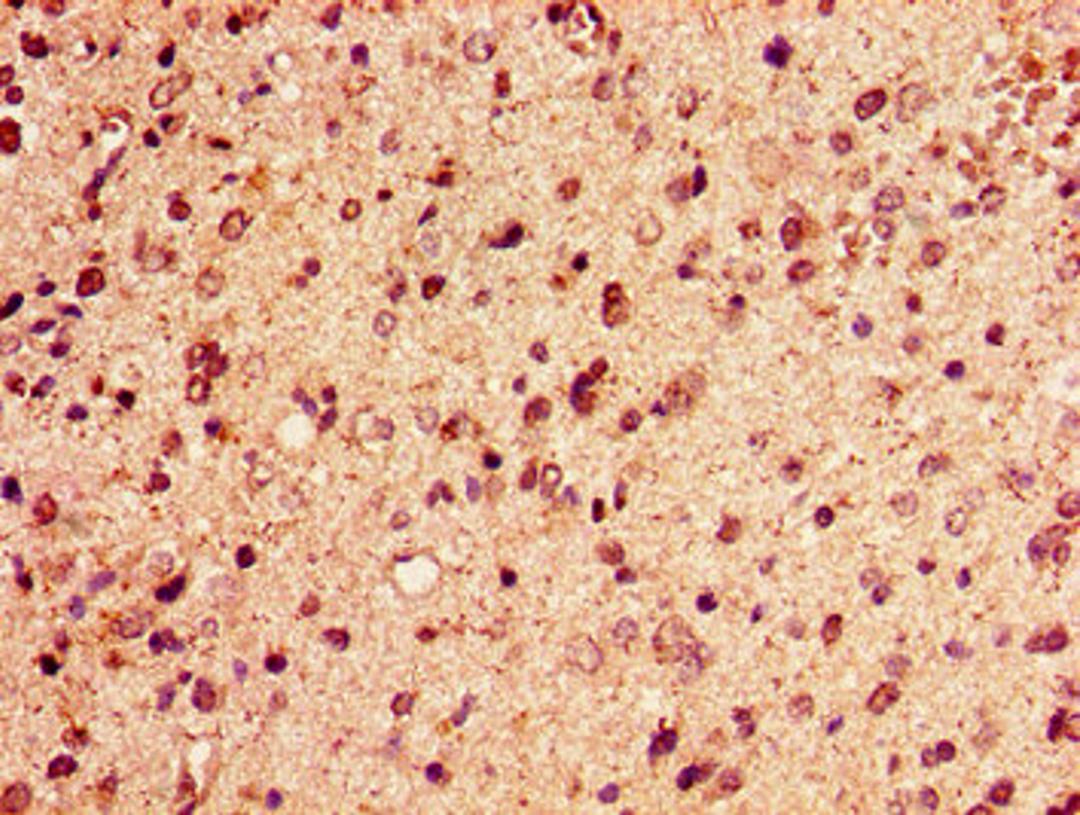 Immunohistochemistry of paraffin-embedded human glioma using CSB-PA010389PA125ncrHU at dilution of 1:100