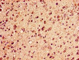 Immunohistochemistry of paraffin-embedded human glioma using CSB-PA010389PA125ncrHU at dilution of 1:100