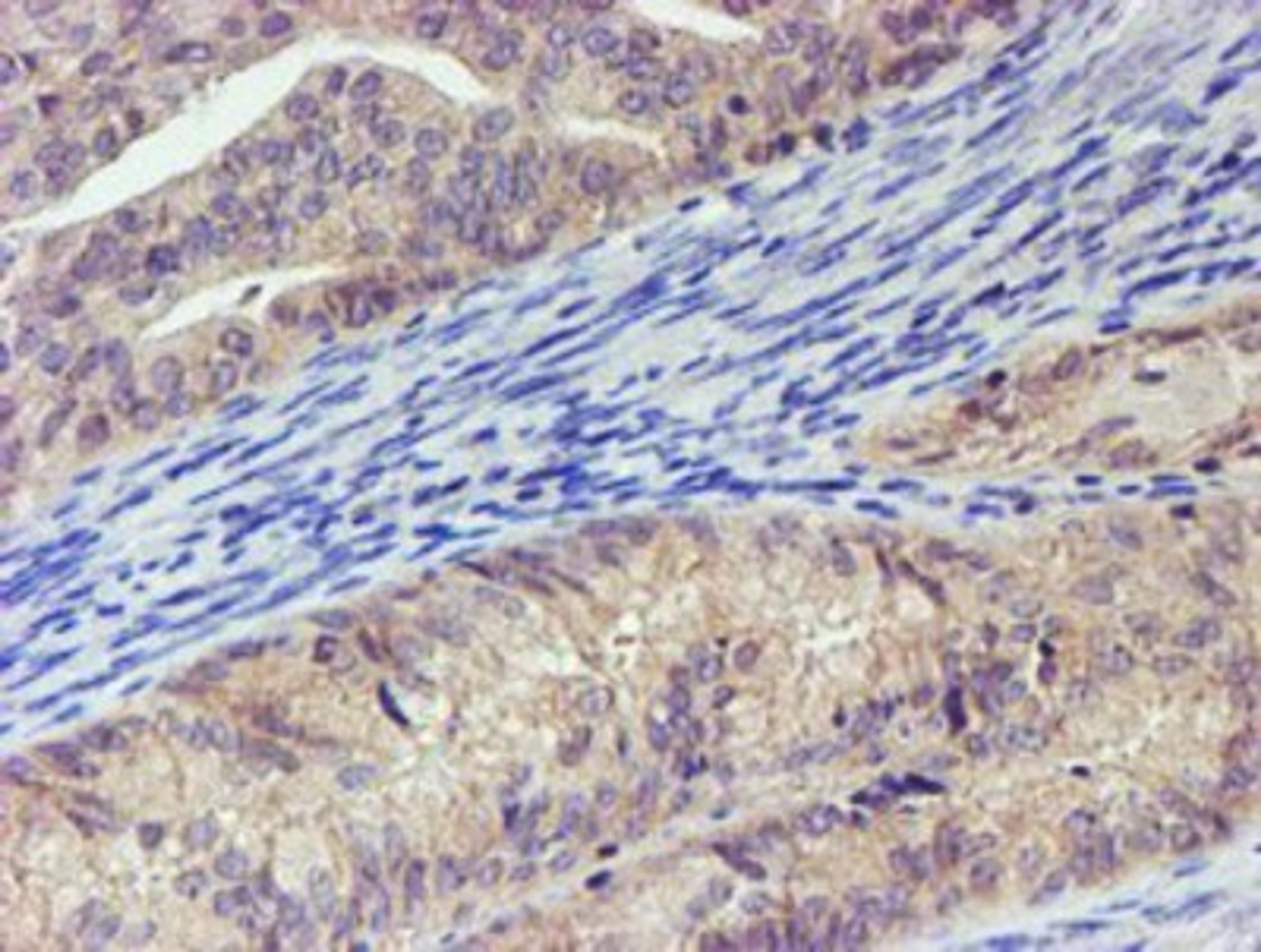 Immunohistochemistry-Paraffin: LECT2 Antibody (2A11) [NBP2-01632] - Staining of paraffin-embedded Adenocarcinoma of Human endometrium tissue using anti-LECT2 mouse monoclonal antibody.