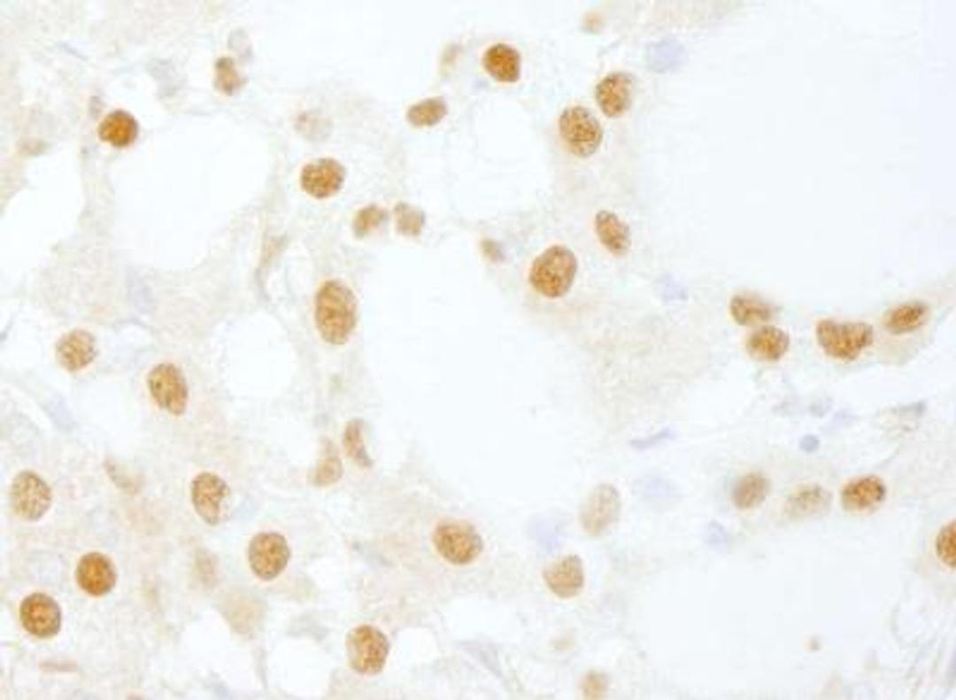 Immunohistochemistry-Paraffin: INTS6 Antibody [NB100-86990] - Human thyroid carcinoma. Antibody used at a dilution of 1:200 (1ug/ml).