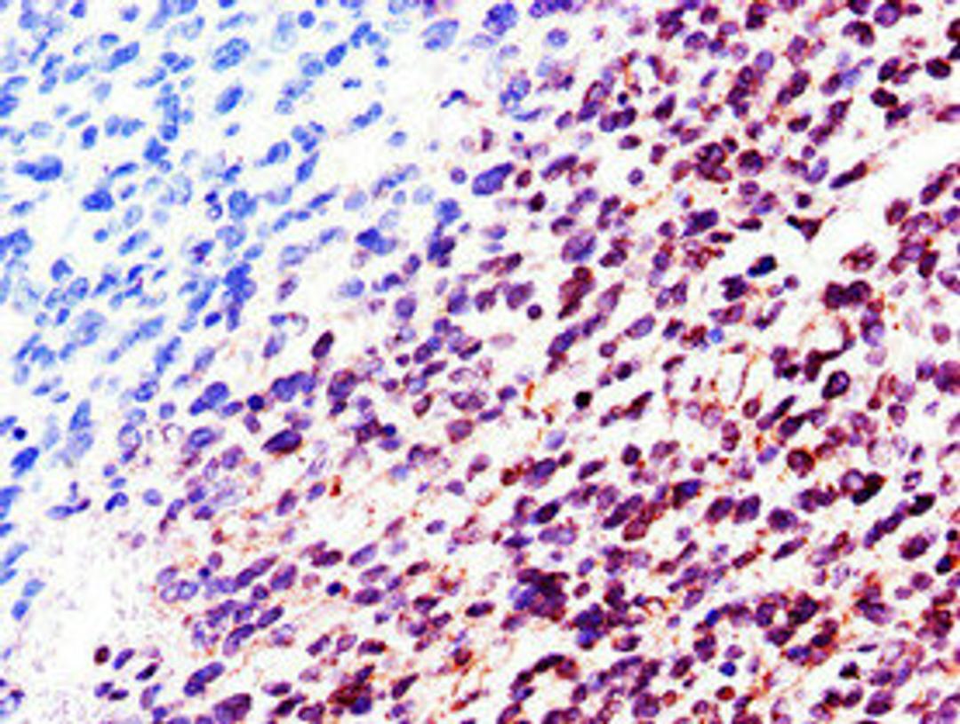 Immunohistochemistry of paraffin-embedded human glioma using CSB-PA013005LA01HU at dilution of 1:100