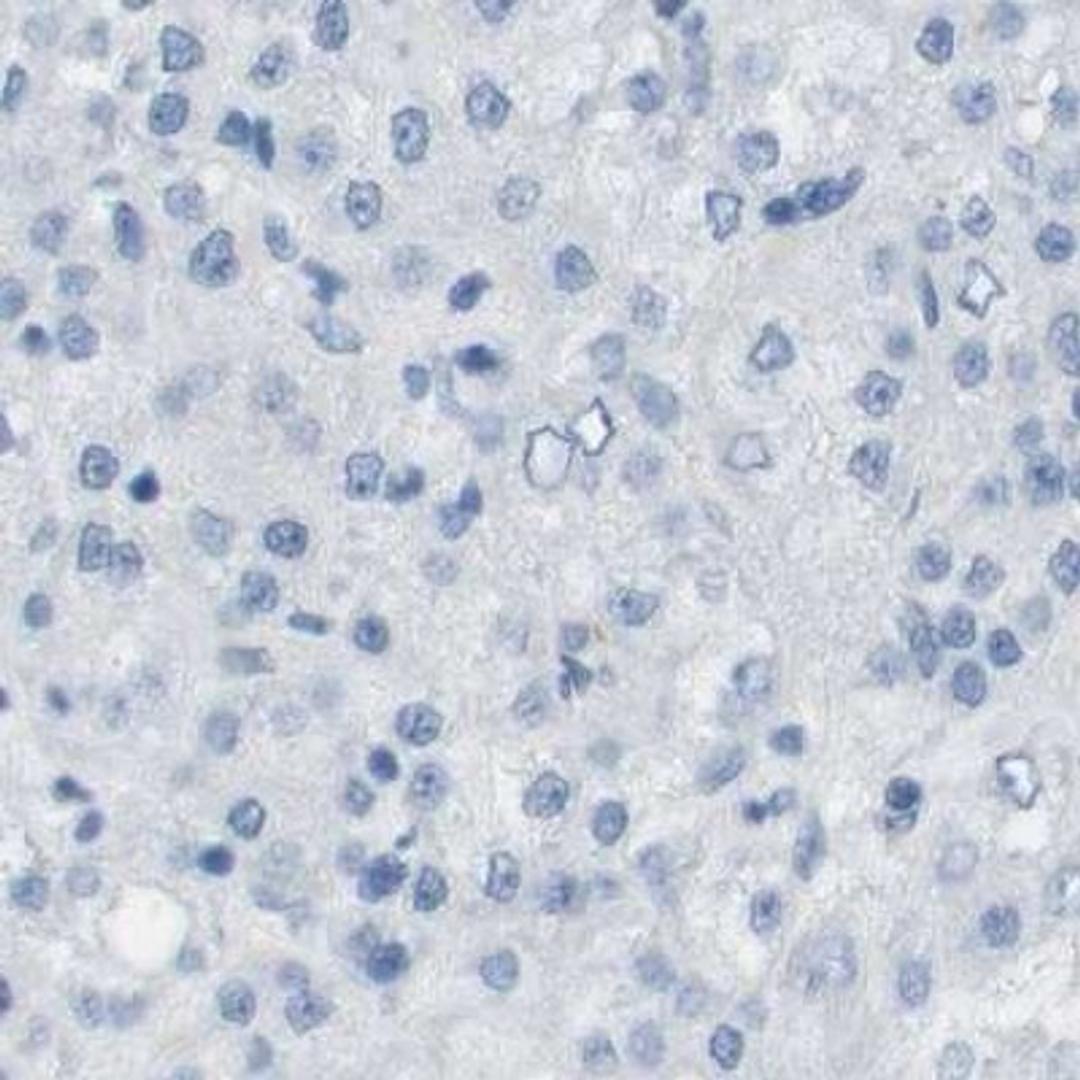 Immunohistochemistry: MS4A10 Antibody [NBP2-31998] - liver cancer