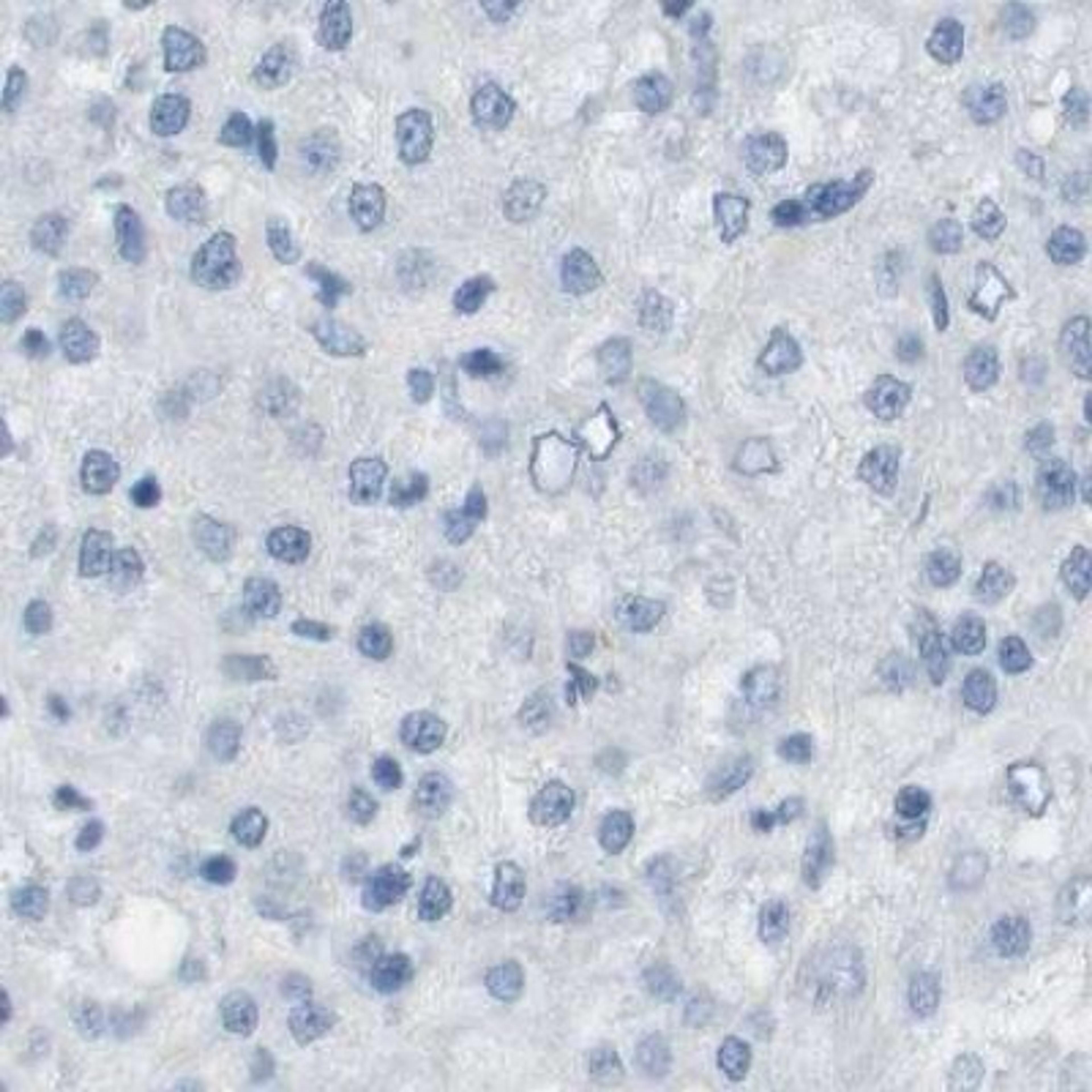 Immunohistochemistry: MS4A10 Antibody [NBP2-31998] - liver cancer