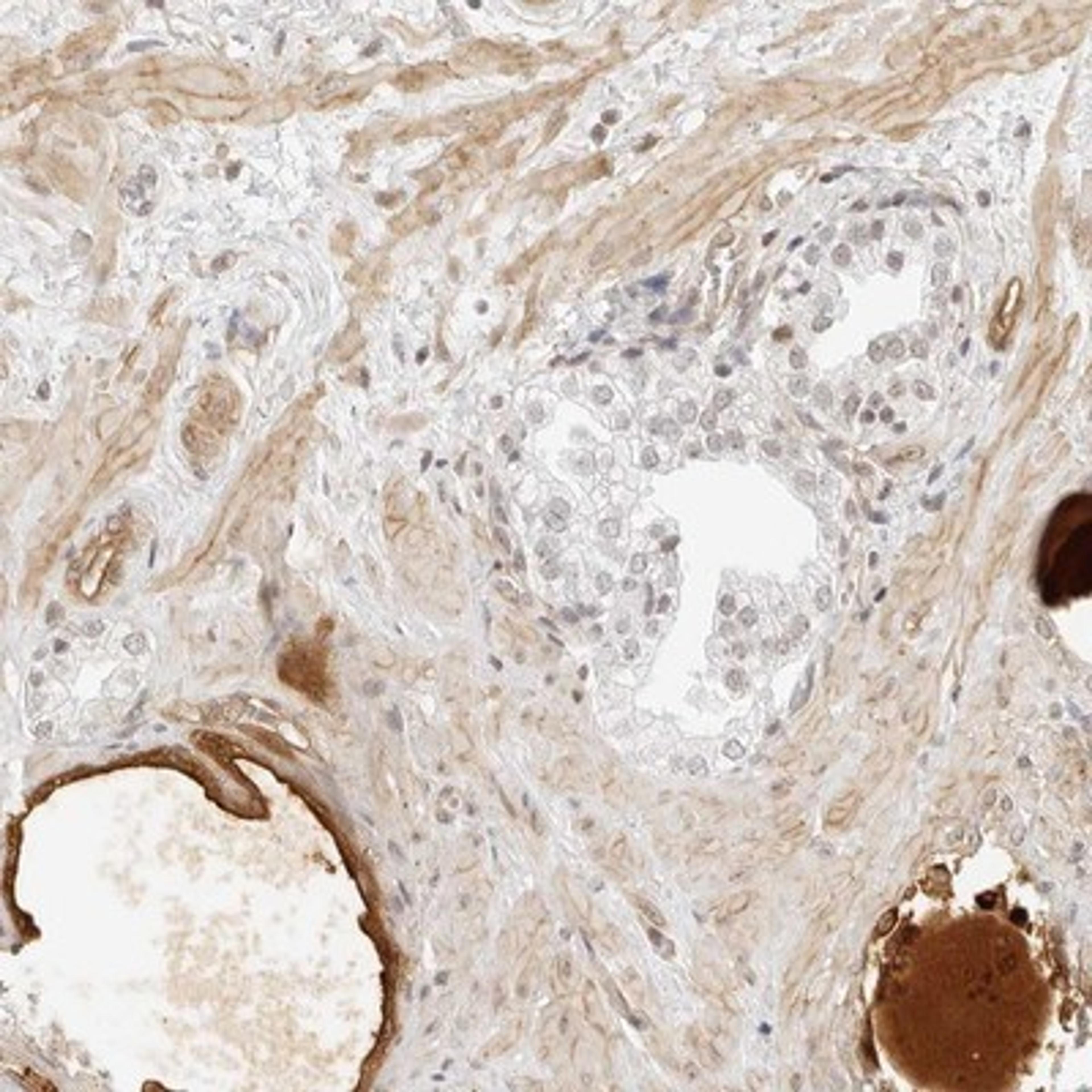 Immunohistochemistry-Paraffin: THSD4 Antibody [NBP1-89243] - Staining of human prostate shows distinct positivity in muscle cells and secreted material.