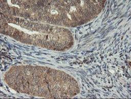 Immunohistochemistry-Paraffin: MAO-A Antibody (2F10) [NBP2-01752] - Staining of paraffin-embedded Adenocarcinoma of Human endometrium tissue using anti-Monoamine Oxidase A mouse monoclonal antibody.