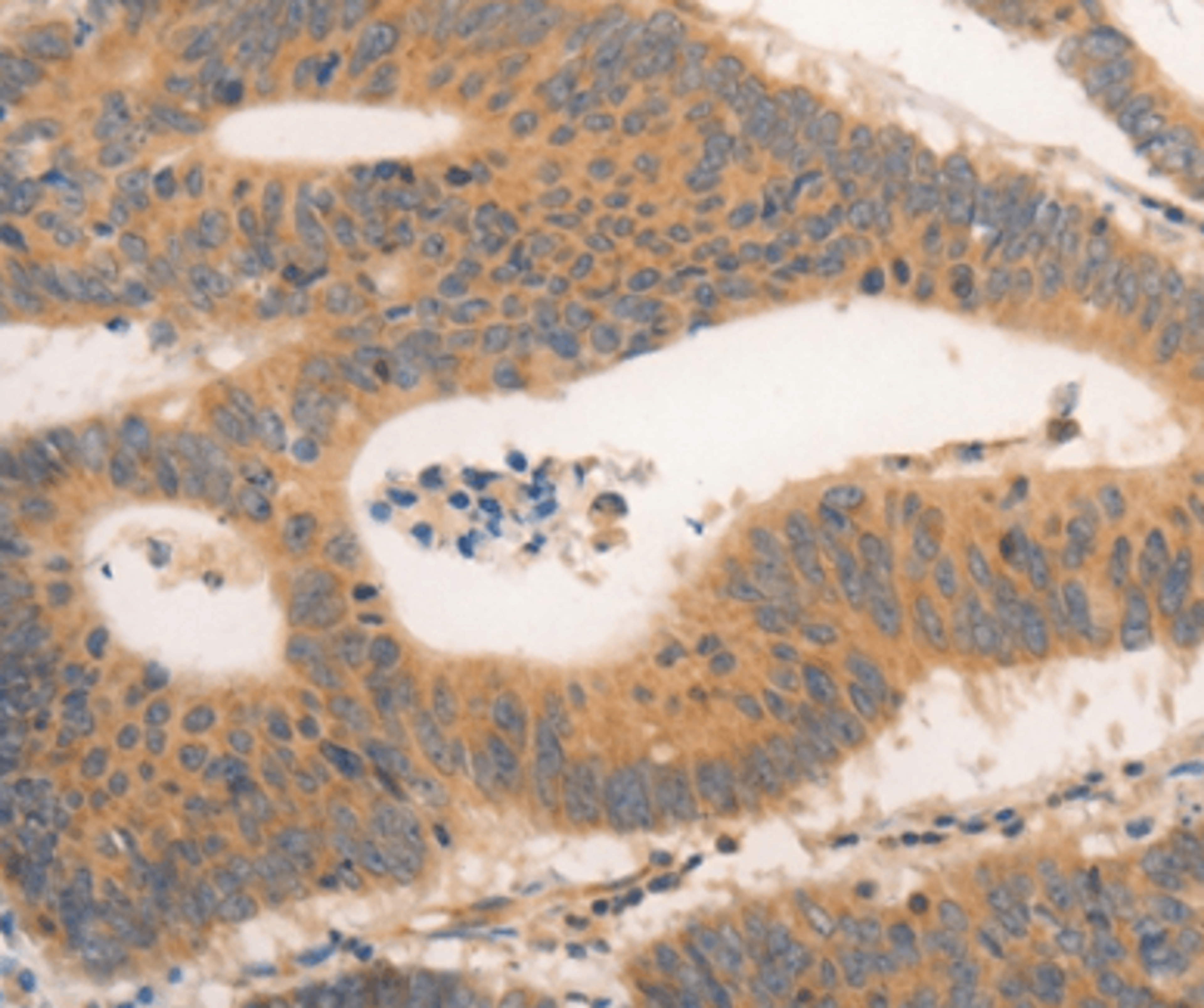 Immunohistochemical analysis of paraffin-embedded Human colon cancer tissue using CSF3R antibody