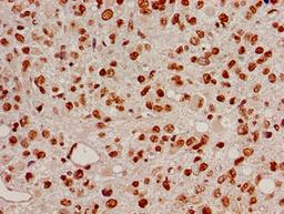 Immunohistochemistry of paraffin-embedded human glioma using CSB-PA010402PA05nacHU at dilution of 1:100