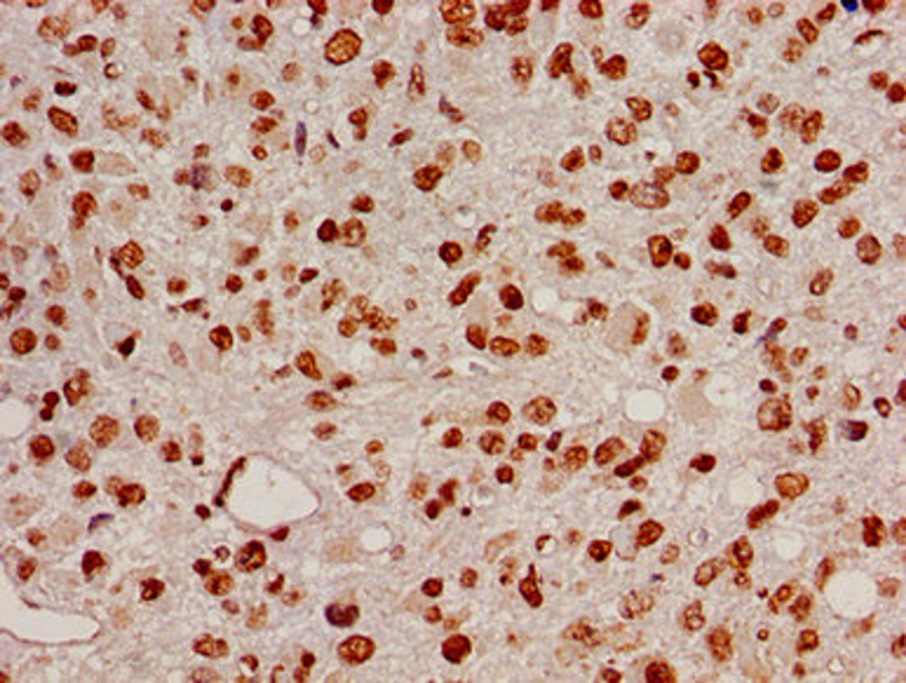 Immunohistochemistry of paraffin-embedded human glioma using CSB-PA010402PA05nacHU at dilution of 1:100