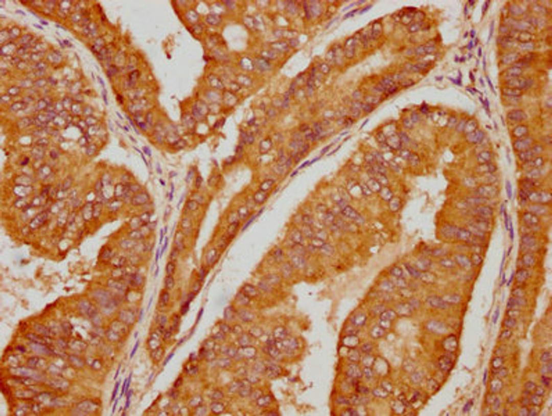 IHC image of CSB-PA011093LA01HU diluted at 1:100 and staining in paraffin-embedded human endometrial cancer performed on a Leica BondTM system. After dewaxing and hydration, antigen retrieval was mediated by high pressure in a citrate buffer (pH 6.0). Section was blocked with 10% normal goat serum 30min at RT. Then primary antibody (1% BSA) was incubated at 4°C overnight. The primary is detected by a biotinylated secondary antibody and visualized using an HRP conjugated SP system.