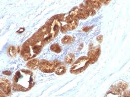 Immunohistochemistry-Paraffin: TAG-72 Antibody (CC49) [NBP2-31383] - Analysis using the Azide and BSA Free version of NBP2-31383. Staining of human Prostate Carcinoma stained with TAG-72 MAb (CC49).