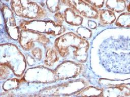 Immunohistochemical staining of human Renal Cell Carcinoma tissue using Mitochondria antibody