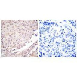 Immunohistochemical analysis of paraffin-embedded human lung carcinoma tissue using Cullin 1 antibody.