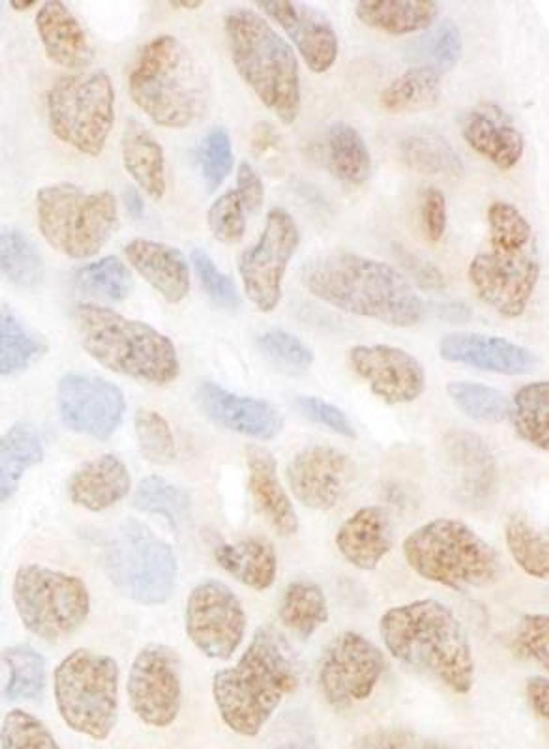 Immunohistochemistry-Paraffin: MTMR15 Antibody [NBP1-42677] - FFPE section of human ovarian carcinoma. Dilution of 1:1,000 (1ug/ml).