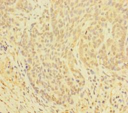 Immunohistochemistry of paraffin-embedded human ovarian cancer using CSB-PA009521EA01HU at dilution of 1:100