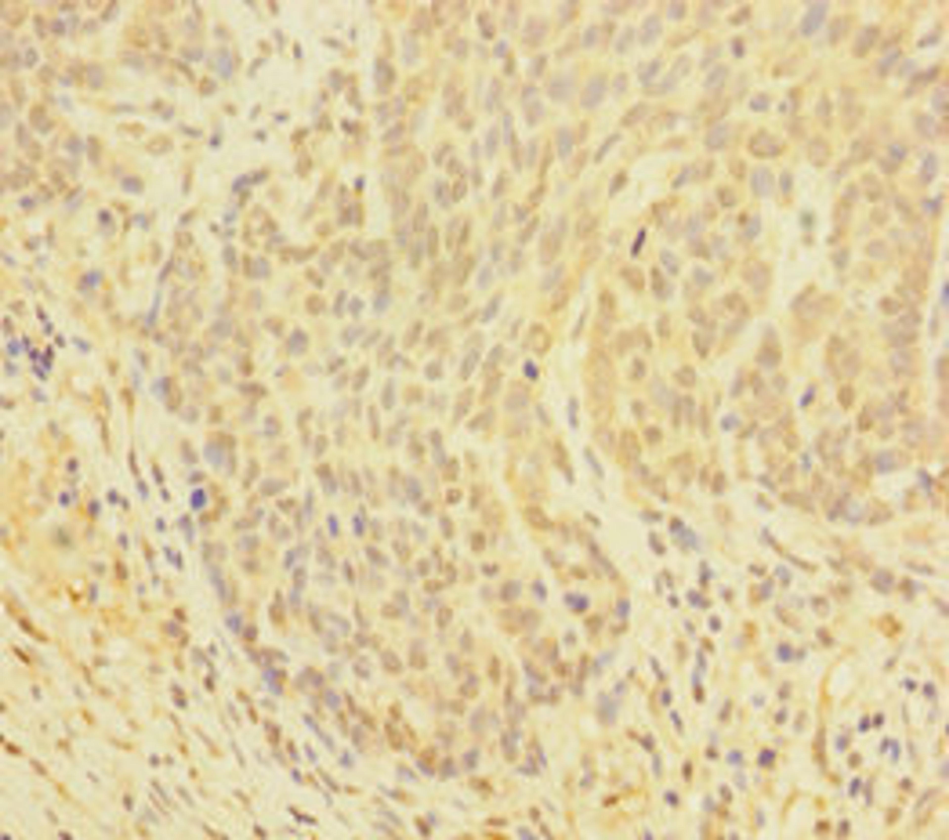 Immunohistochemistry of paraffin-embedded human ovarian cancer using CSB-PA009521EA01HU at dilution of 1:100