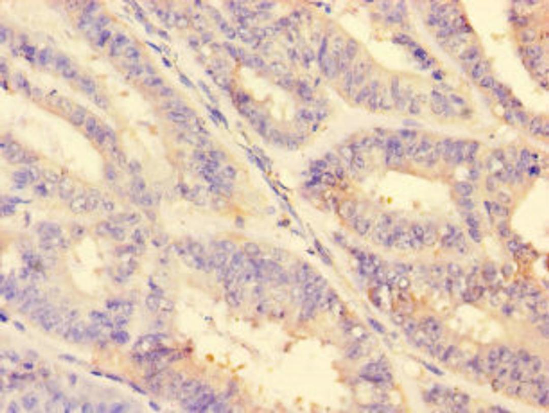 Immunohistochemistry of paraffin-embedded human endometrial cancer using CSB-PA06879A0Rb at dilution of 1:100
