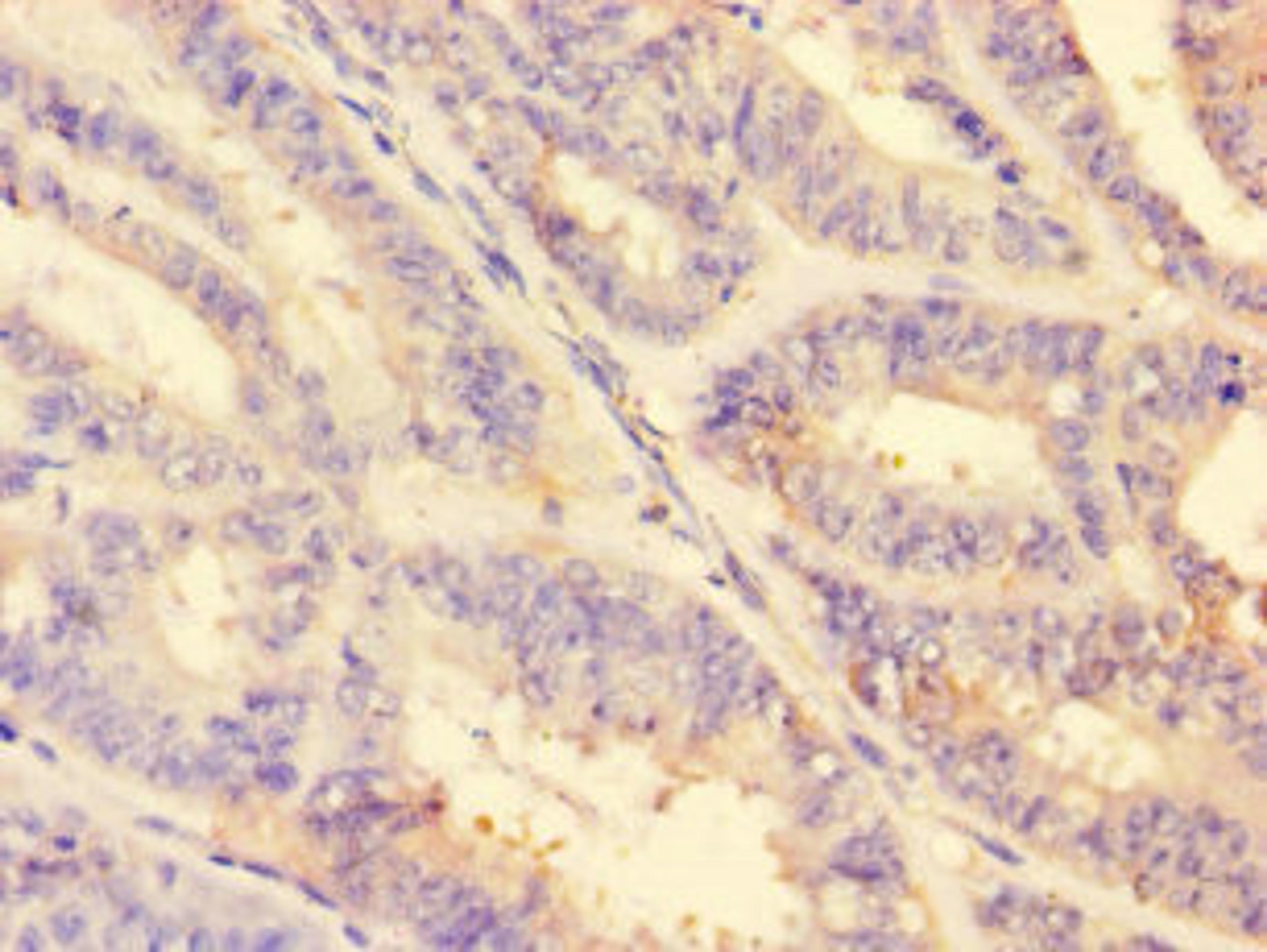 Immunohistochemistry of paraffin-embedded human endometrial cancer using CSB-PA06879A0Rb at dilution of 1:100