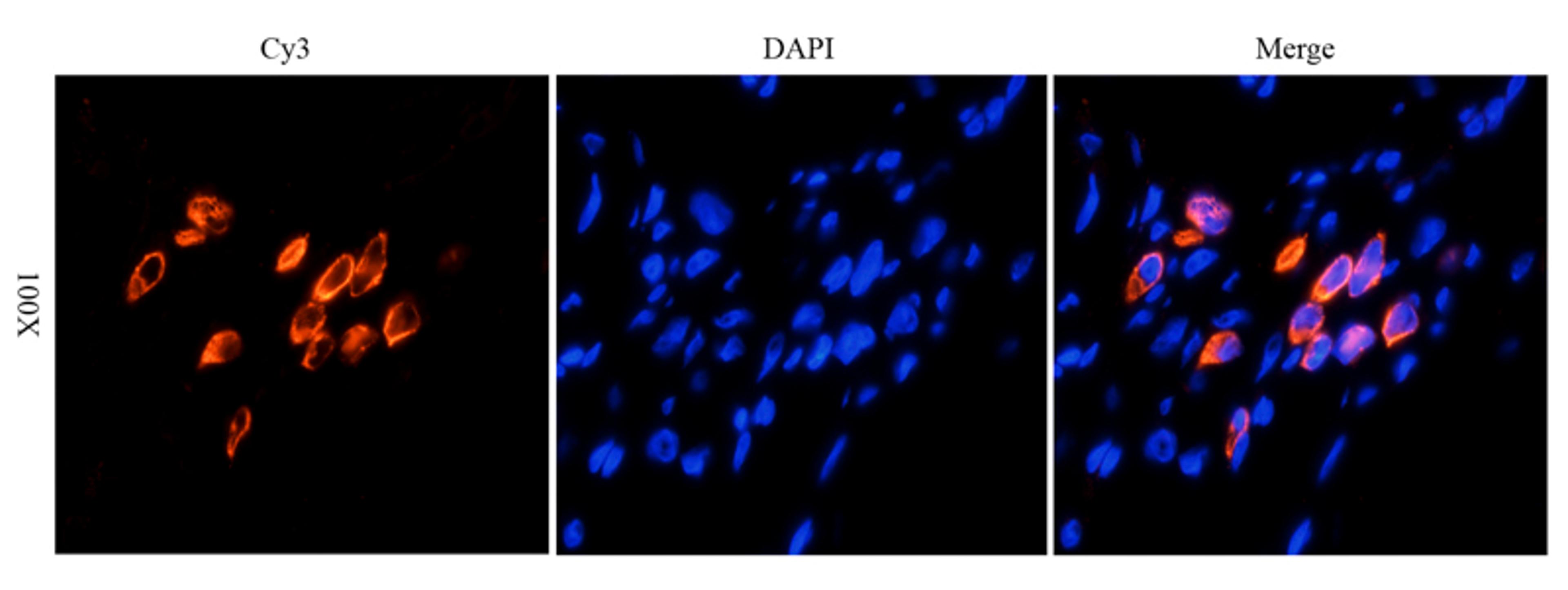 IF analysis of human ovarian cancer tissue using HE4 antibody (dilution of primary antibody at 1:100)