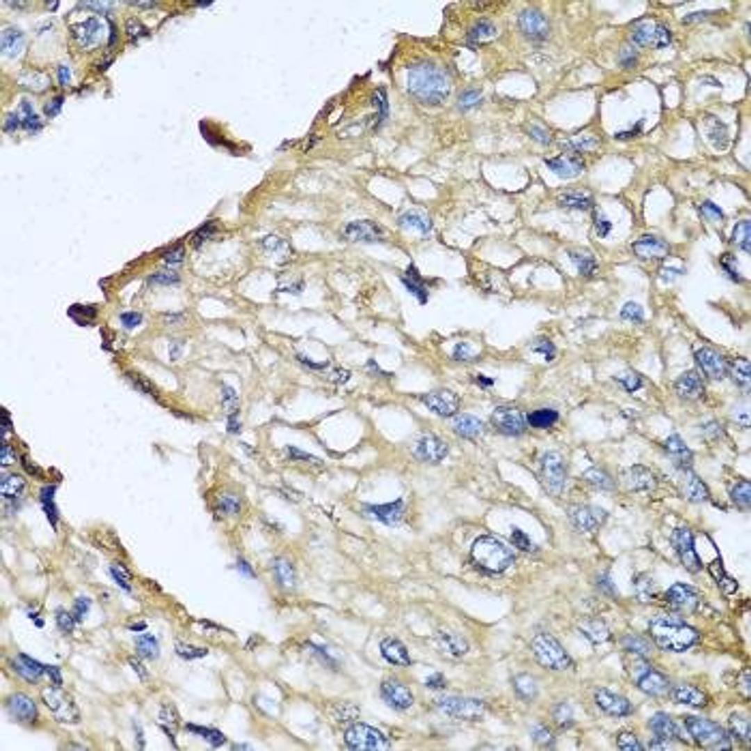 Immunohistochemical staining of human prostate cancer tissue using ASIP antibody (dilution of 1:100)