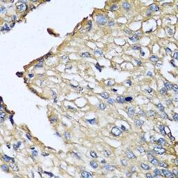 Immunohistochemical staining of human prostate cancer tissue using ASIP antibody (dilution of 1:100)