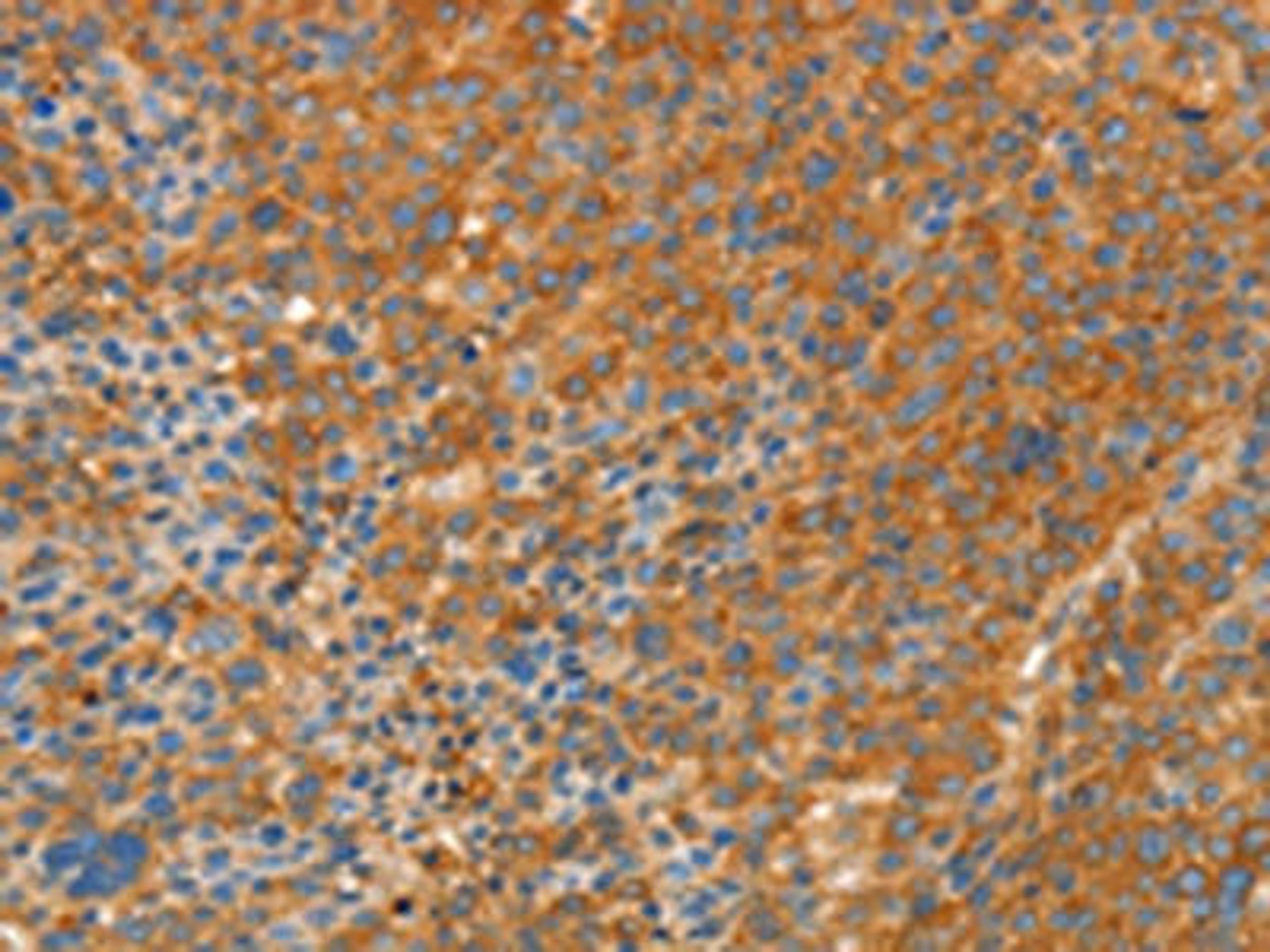 The image on the left is immunohistochemistry of paraffin-embedded Human liver cancer tissue using CSB-PA089809(APPL1 Antibody) at dilution 1/30, on the right is treated with fusion protein. (Original magnification: ×200)