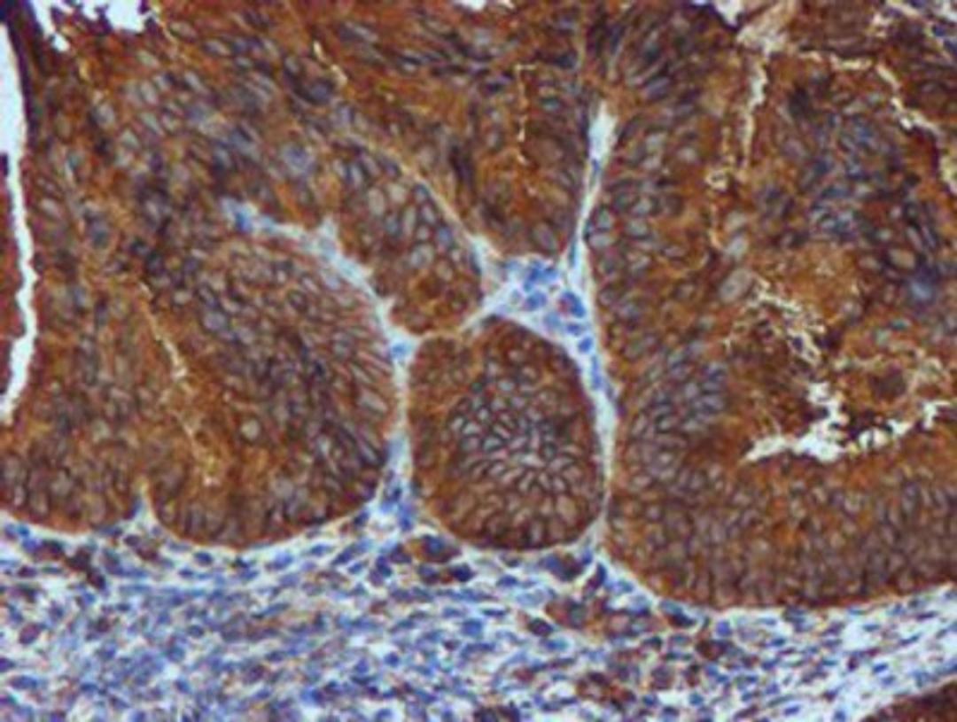 Immunohistochemistry-Paraffin: ERp72 Antibody (2B9) [NBP2-01652] - Staining of paraffin-embedded Adenocarcinoma of Human endometrium tissue using anti-ERp72 mouse monoclonal antibody.