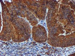 Immunohistochemistry-Paraffin: ERp72 Antibody (2B9) [NBP2-01652] - Staining of paraffin-embedded Adenocarcinoma of Human endometrium tissue using anti-ERp72 mouse monoclonal antibody.