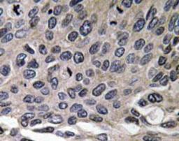 Immunohistochemistry-Paraffin: Macrophage Inflammatory Protein 1 alpha Antibody [NBP1-19800] -  Human lung carcinoma tissue.