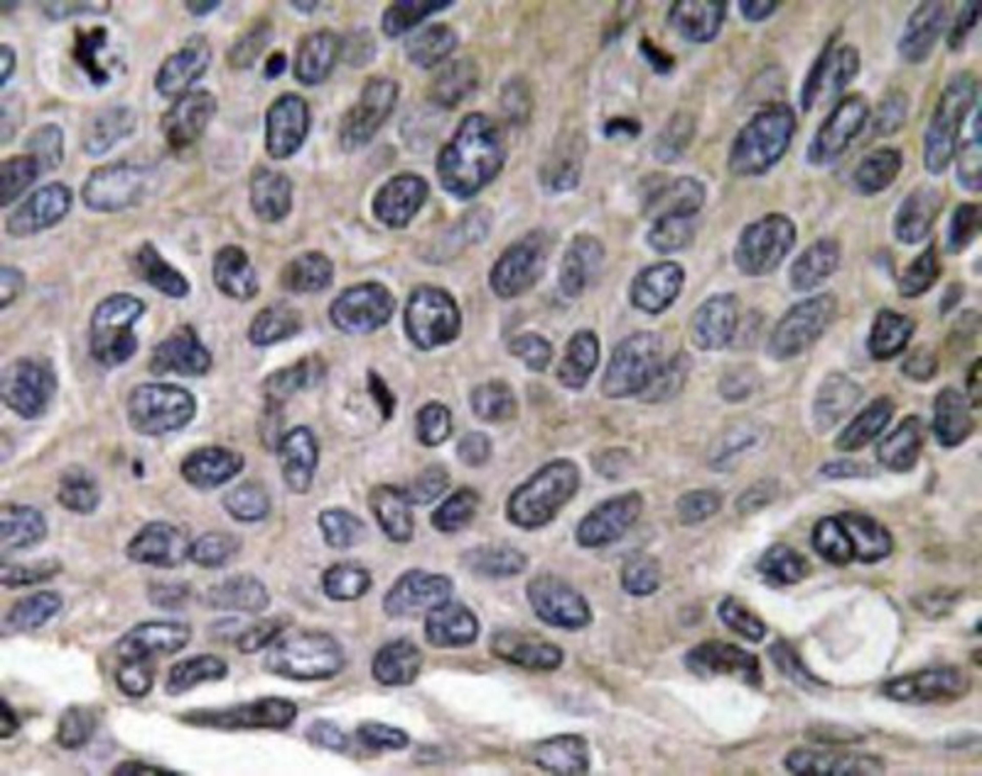 Immunohistochemistry-Paraffin: Macrophage Inflammatory Protein 1 alpha Antibody [NBP1-19800] -  Human lung carcinoma tissue.