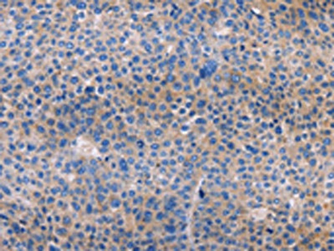 The image on the left is immunohistochemistry of paraffin-embedded Human liver cancer tissue using CSB-PA248410(AMACR Antibody) at dilution 1/30, on the right is treated with fusion protein. (Original magnification: ×200)