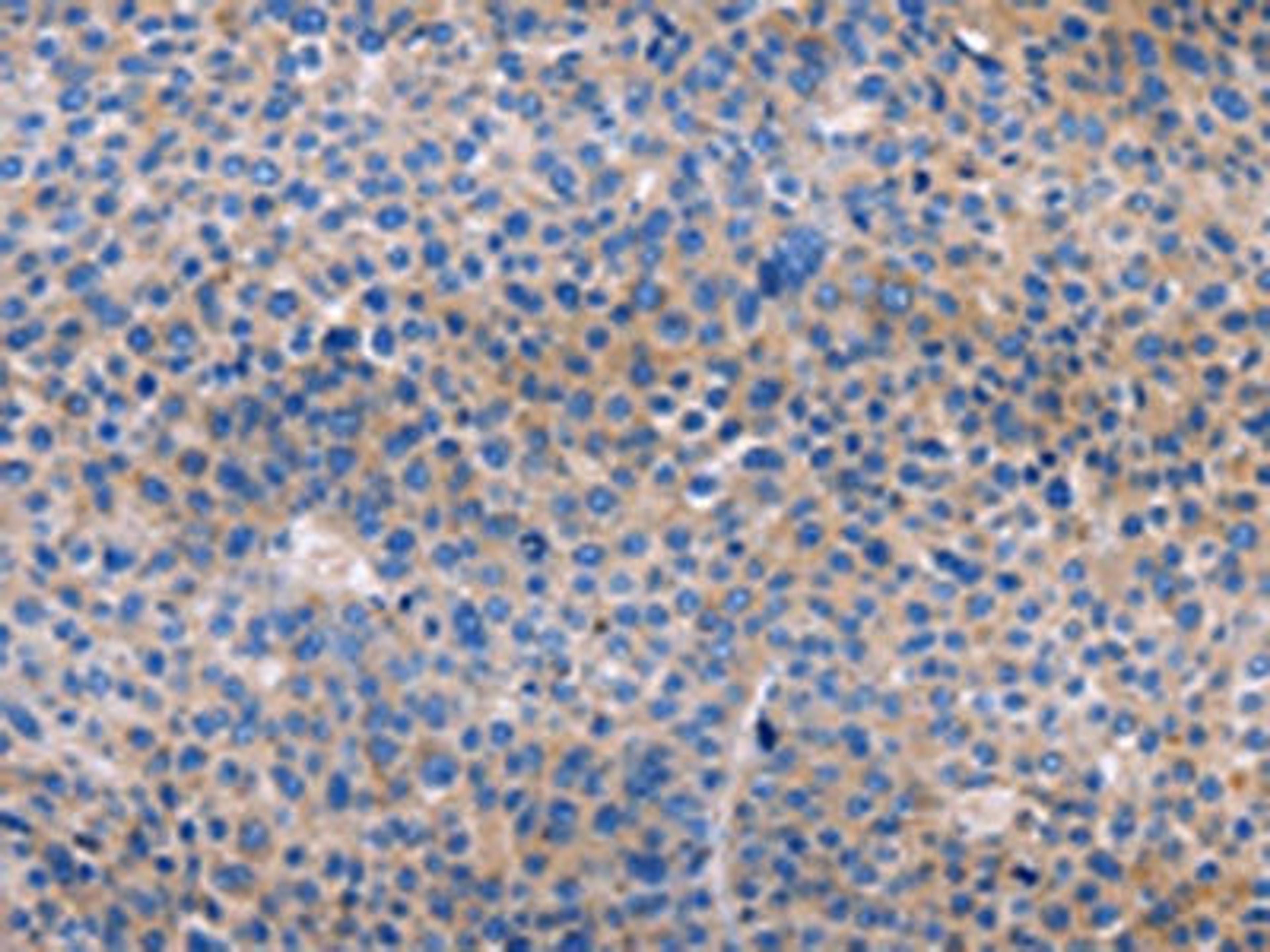 The image on the left is immunohistochemistry of paraffin-embedded Human liver cancer tissue using CSB-PA248410(AMACR Antibody) at dilution 1/30, on the right is treated with fusion protein. (Original magnification: ×200)