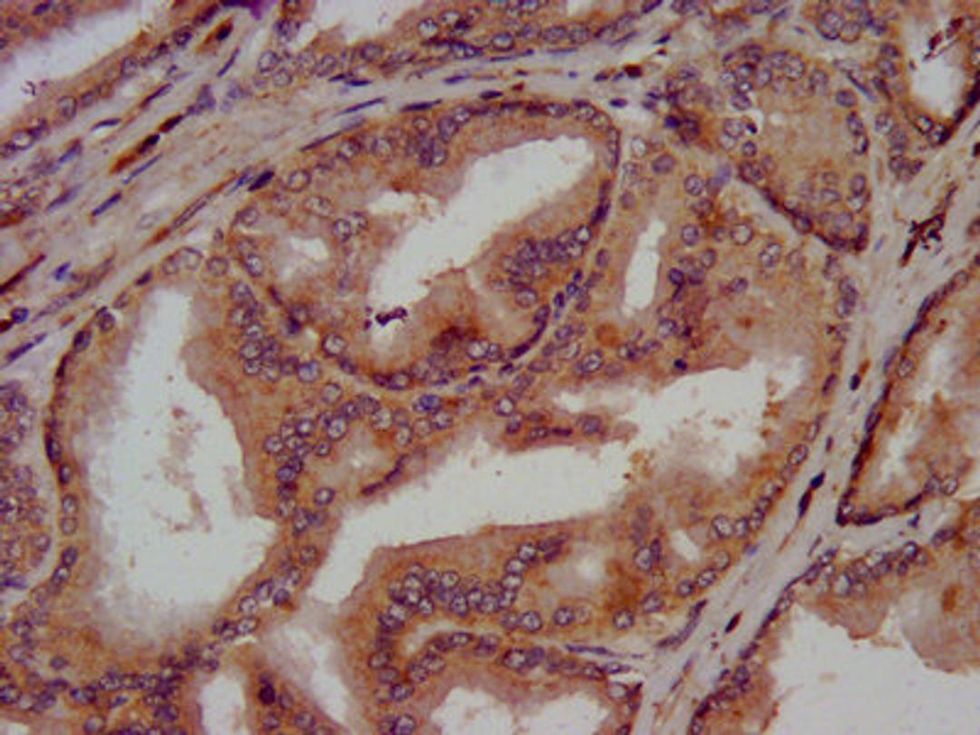 IHC image of CSB-PA005567LA01HU diluted at 1:300 and staining in paraffin-embedded human prostate tissue performed on a Leica BondTM system. After dewaxing and hydration, antigen retrieval was mediated by high pressure in a citrate buffer (pH 6.0). Section was blocked with 10% normal goat serum 30min at RT. Then primary antibody (1% BSA) was incubated at 4°C overnight. The primary is detected by a biotinylated secondary antibody and visualized using an HRP conjugated SP system.