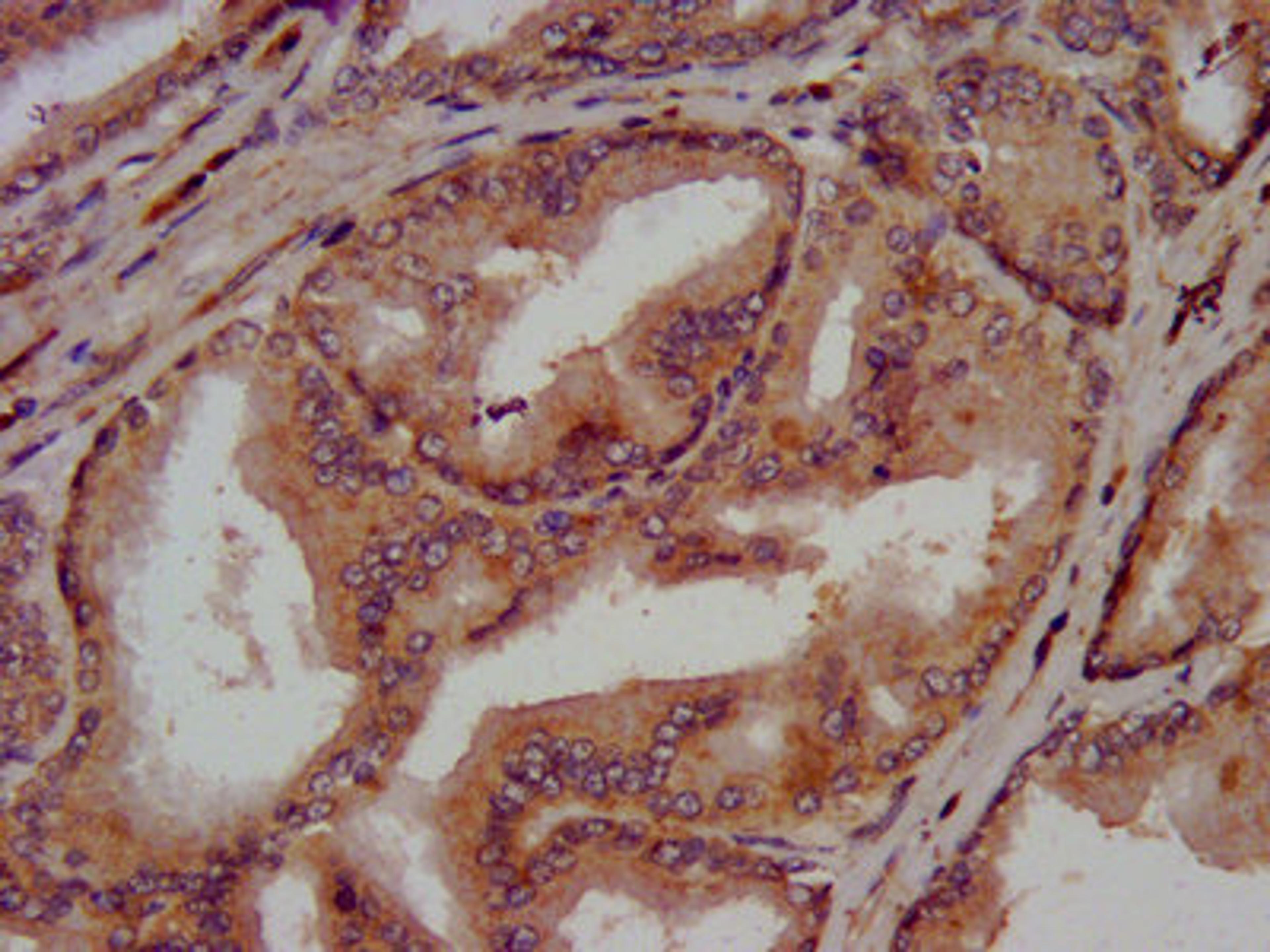 IHC image of CSB-PA005567LA01HU diluted at 1:300 and staining in paraffin-embedded human prostate tissue performed on a Leica BondTM system. After dewaxing and hydration, antigen retrieval was mediated by high pressure in a citrate buffer (pH 6.0). Section was blocked with 10% normal goat serum 30min at RT. Then primary antibody (1% BSA) was incubated at 4°C overnight. The primary is detected by a biotinylated secondary antibody and visualized using an HRP conjugated SP system.
