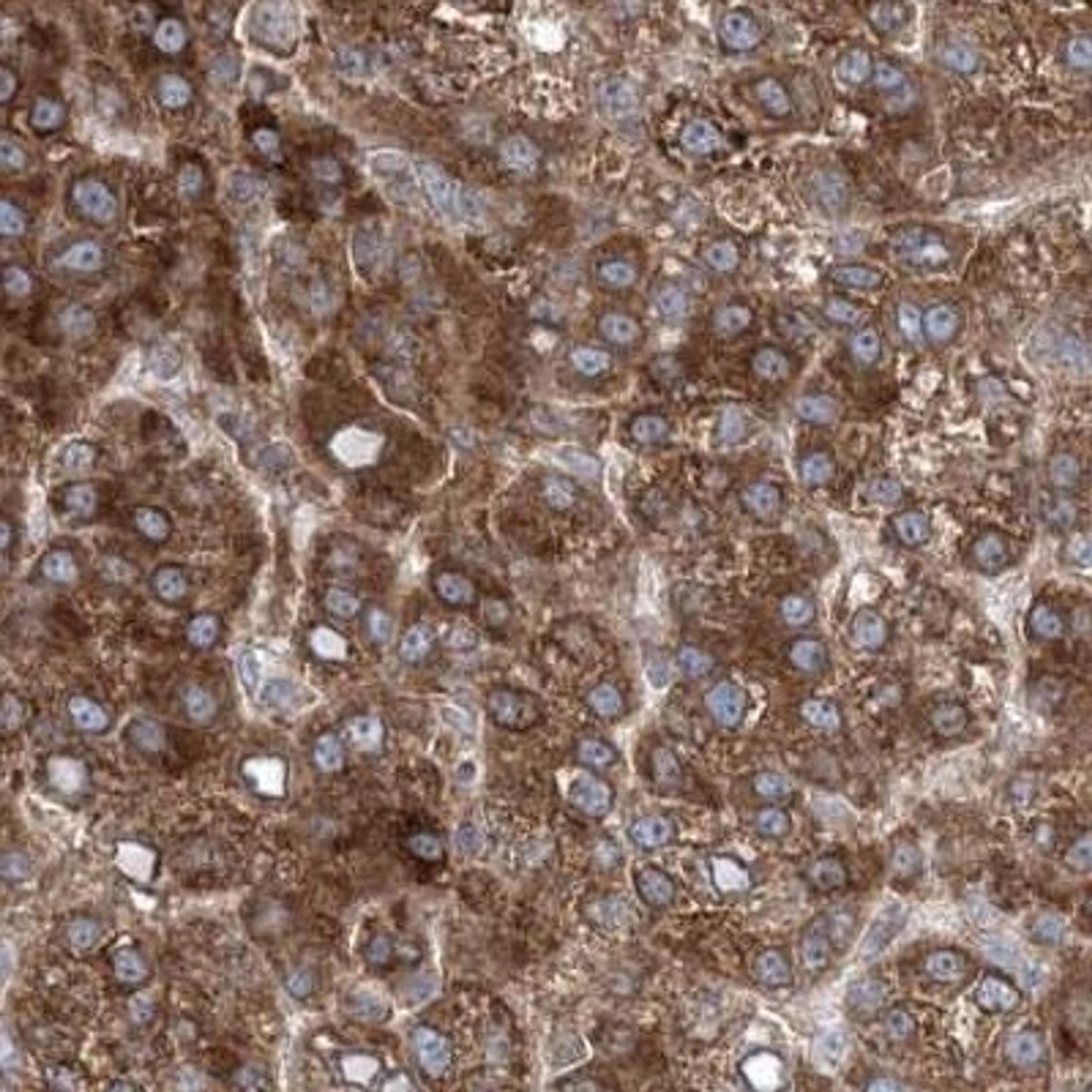 Immunohistochemistry: ALLC Antibody [NBP2-32700] - liver cancer