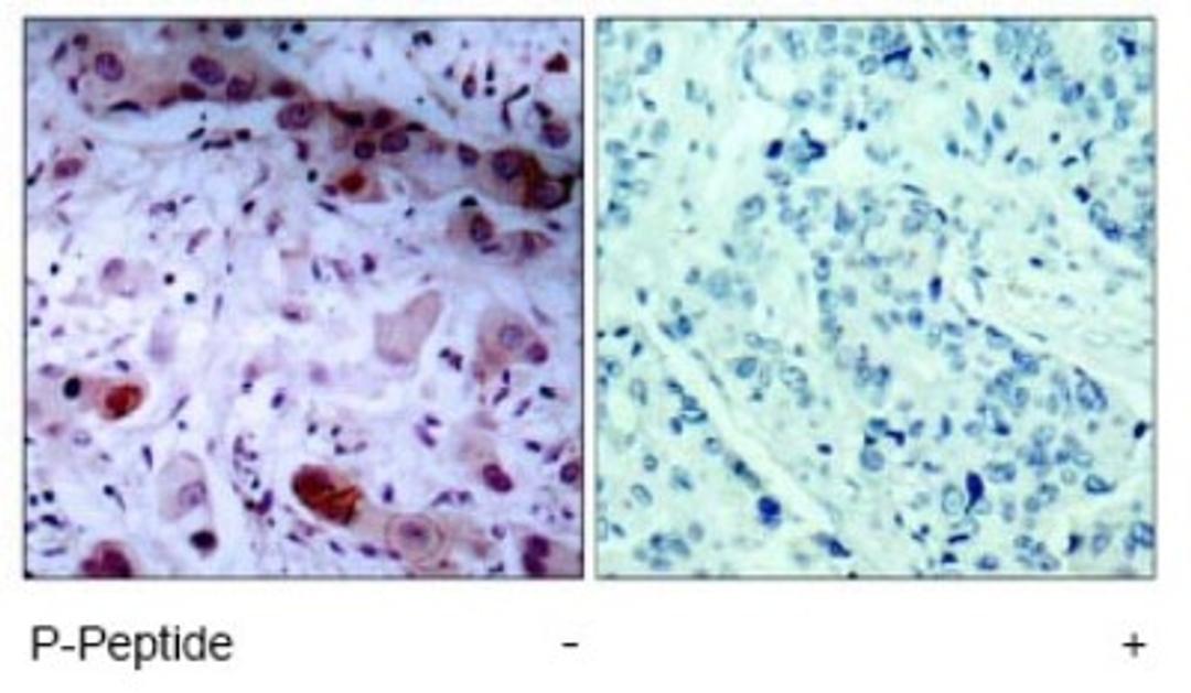 Immunohistochemistry: JAK1 [p Tyr1022] Antibody [NB100-82005] - Immunohistochemical analysis of paraffin-embedded human breast carcinoma tissue, using JAK1 (phospho-Tyr1022) antibody