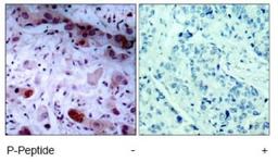 Immunohistochemistry: JAK1 [p Tyr1022] Antibody [NB100-82005] - Immunohistochemical analysis of paraffin-embedded human breast carcinoma tissue, using JAK1 (phospho-Tyr1022) antibody