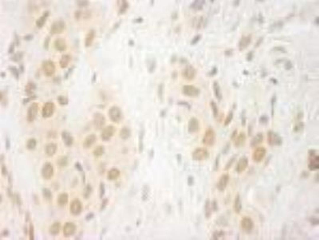 Immunohistochemistry-Paraffin: BPTF/FALZ Antibody [NB100-41418] - FFPE section of human breast carcinoma.  Affinity purified rabbit anti-FALZ/BPTF used at a dilution of 1:250.