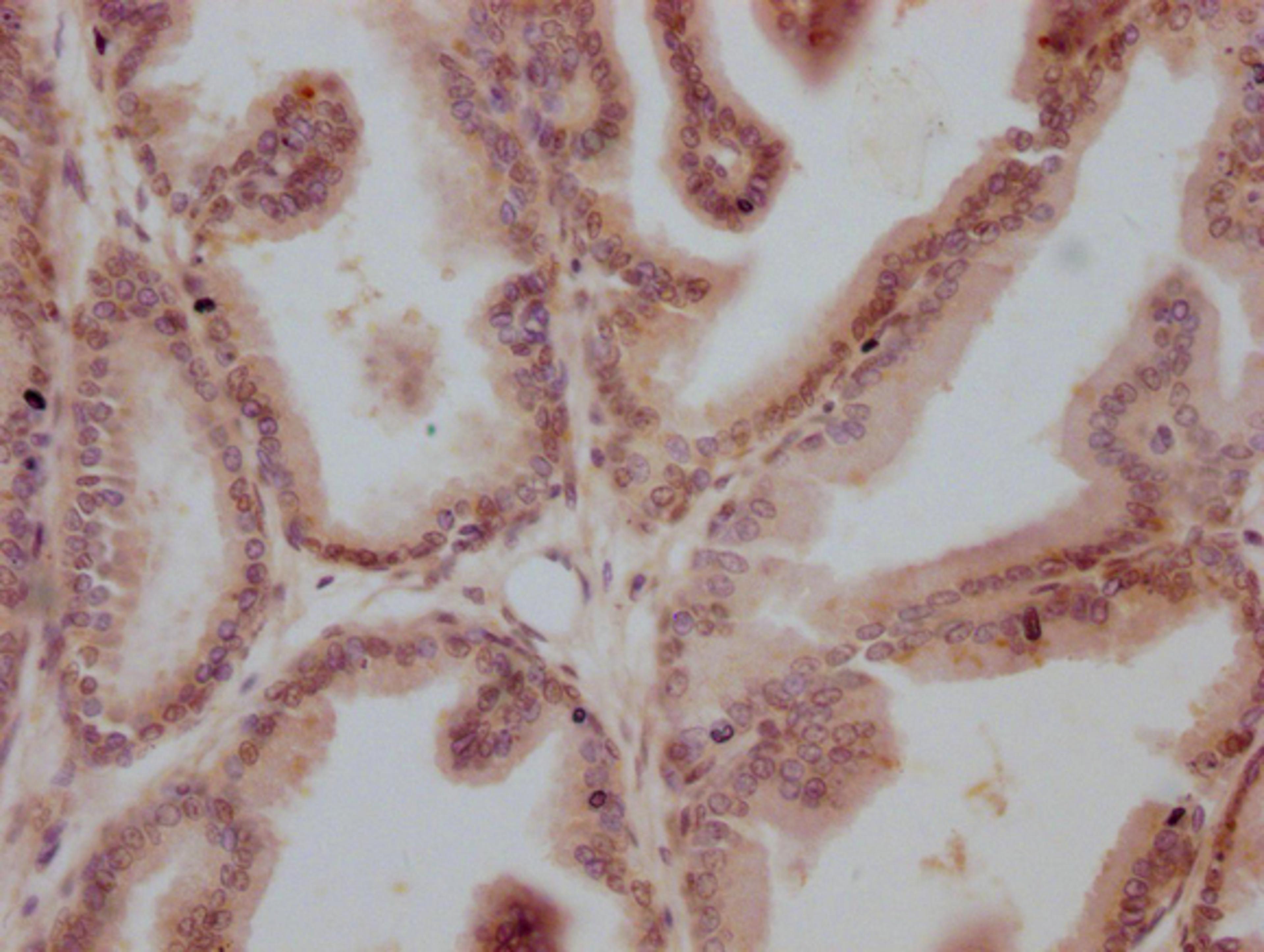 IHC image of CSB-MA999605 diluted at 1:100 and staining in paraffin-embedded human prostate cancer performed on a Leica BondTM system. After dewaxing and hydration, antigen retrieval was mediated by high pressure in a citrate buffer (pH 6.0). Section was blocked with 10% normal goat serum 30min at RT. Then primary antibody (1% BSA) was incubated at 4°C overnight. The primary is detected by a Goat anti-mouse IgG polymer labeled by HRP and visualized using 0.05% DAB.