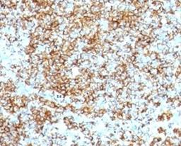 Formalin-fixed, paraffin-embedded human lymphoma stained with anti-CD45RB antibody (SPM569).