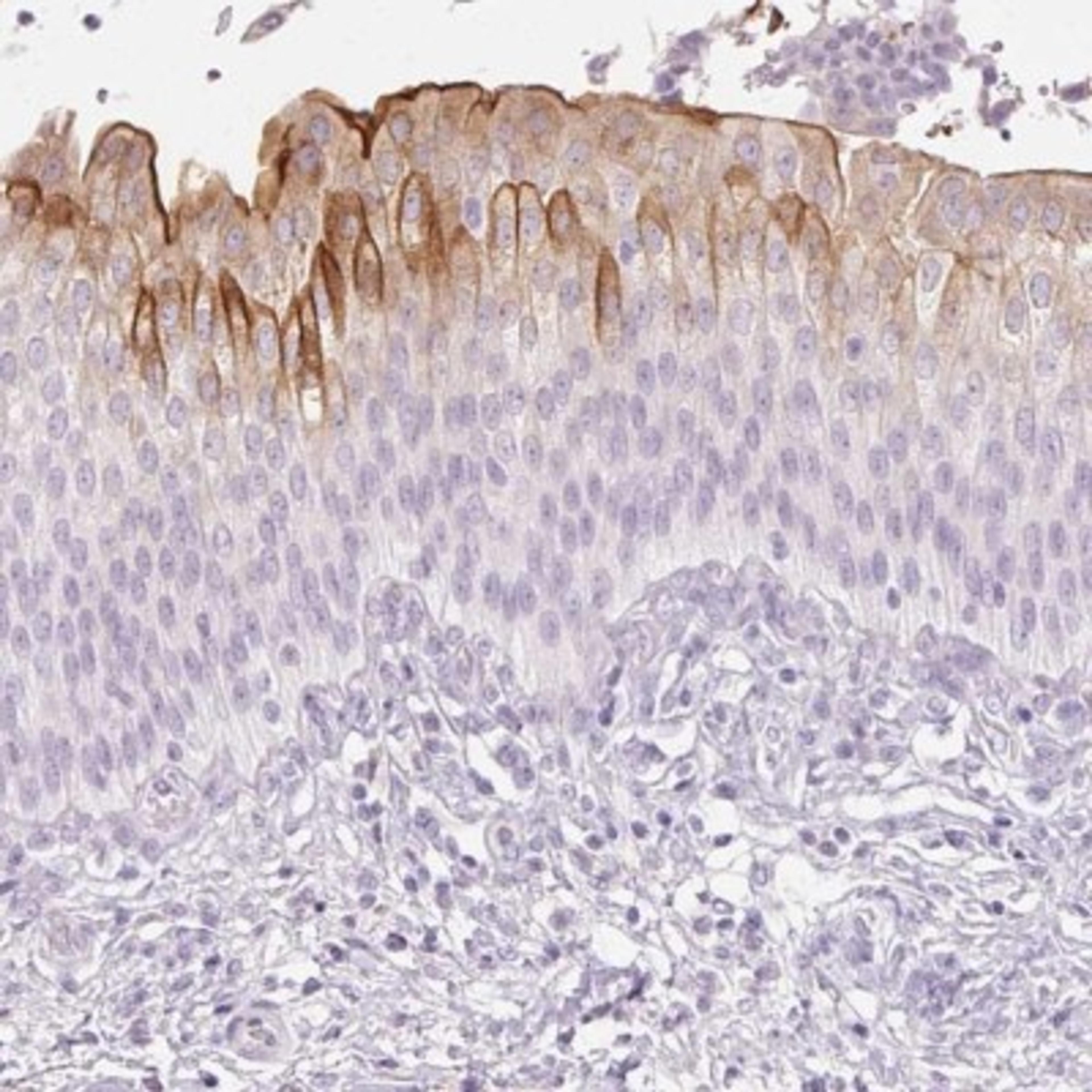 Immunohistochemistry: Uroplakin II Antibody [NBP2-38904] - Staining of human urinary bladder shows strong membranous positivity in urothelial cells.