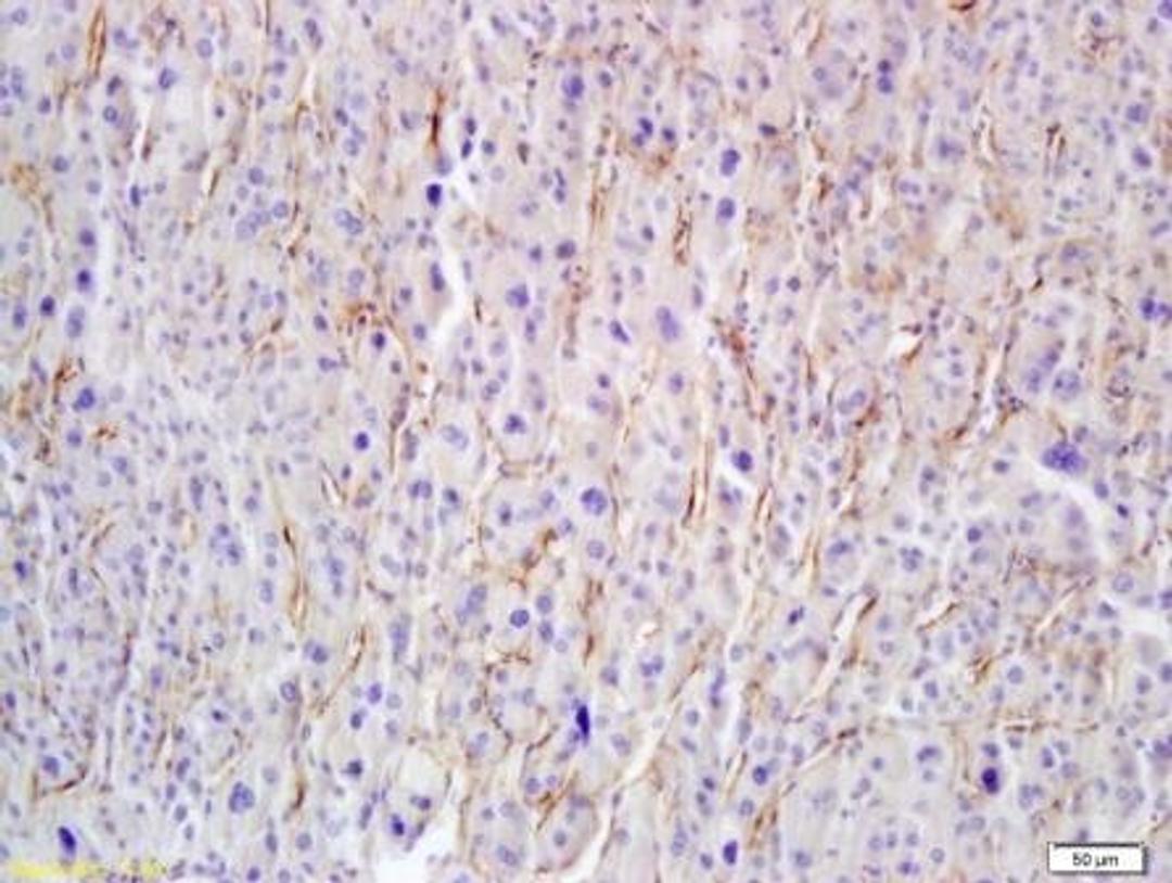 IHC-P of carcinoma tissue (1:200 dilution) using hyaluronidase antibody