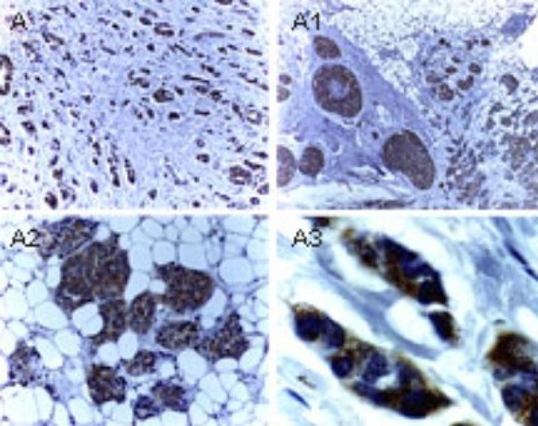 Immunohistochemistry-Paraffin: XIAP Antibody [NB100-56183] - Analysis of XIAP in formalin-fixed, paraffin-embedded human breast carcinoma using this antibody at 1:2000. A-A3, successively higher magnifications of the breast carcinoma tissue section. Hematoxylin-eosin counterstain.