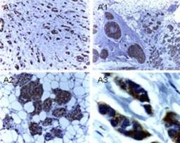 Immunohistochemistry-Paraffin: XIAP Antibody [NB100-56183] - Analysis of XIAP in formalin-fixed, paraffin-embedded human breast carcinoma using this antibody at 1:2000. A-A3, successively higher magnifications of the breast carcinoma tissue section. Hematoxylin-eosin counterstain.