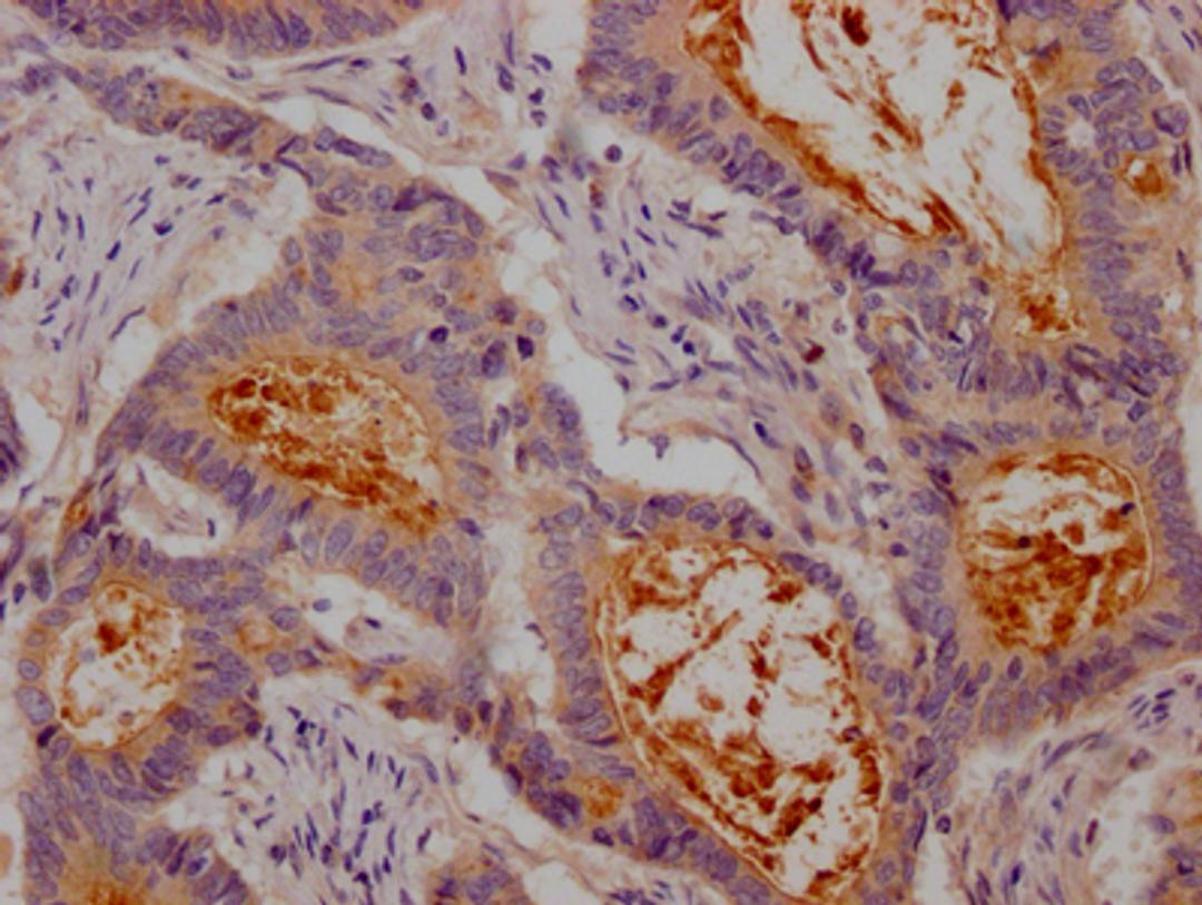 IHC image of CSB-RA147192A0HU diluted at 1:100 and staining in paraffin-embedded human colon cancer performed on a Leica BondTM system. After dewaxing and hydration, antigen retrieval was mediated by high pressure in a citrate buffer (pH 6.0). Section was blocked with 10% normal goat serum 30min at RT. Then primary antibody (1% BSA) was incubated at 4℃ overnight. The primary is detected by a Goat anti-rabbit IgG polymer labeled by HRP and visualized using 0.05% DAB.